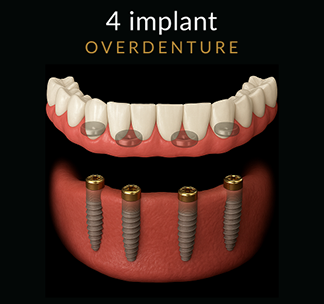 Overdenture